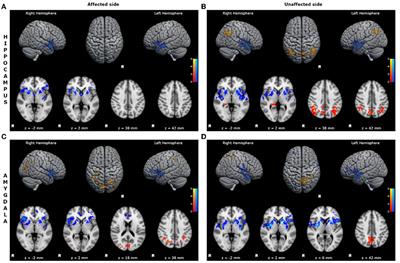 Distinct limbic connectivity in left and right benign mesial temporal lobe epilepsy: Evidence from a resting state functional MRI study